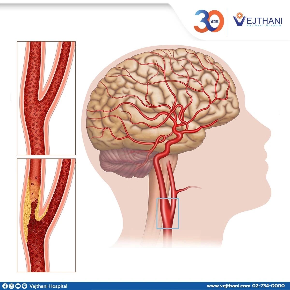 Illustration of carotid artery disease